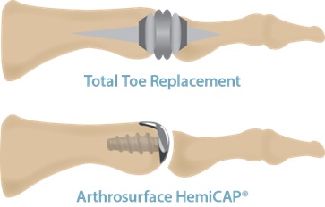 Toe Joint Replacements