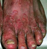 severe athlete's foot