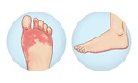 athete's foot diagram