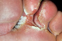 athete's foot crusty toes