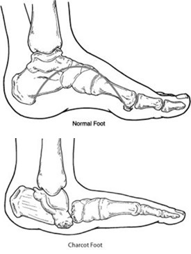 charcot foot