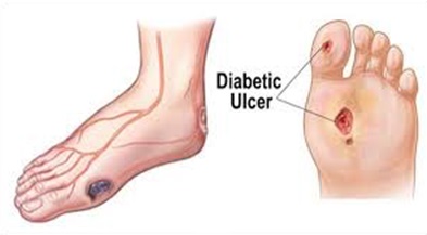 foot ulcers
