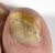 fungal nails thumbnail