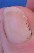 ingrowing toenail type 1