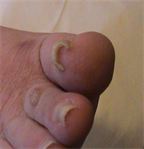 ingrowing toenail type 2