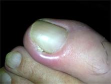 ingrowing toenail type 3