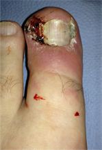 ingrowing toenail type 4