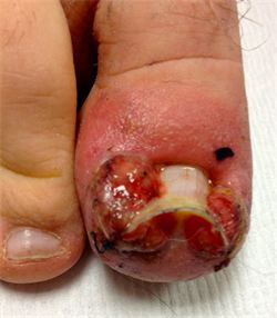 ingrowing toenail type 5