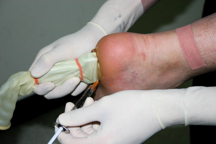 Ultrasound guided injection for plantar fasciitis