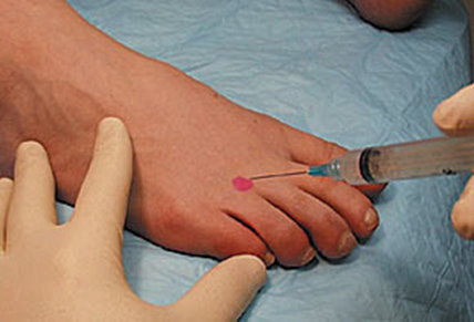 Injection of Morton’s Neuroma