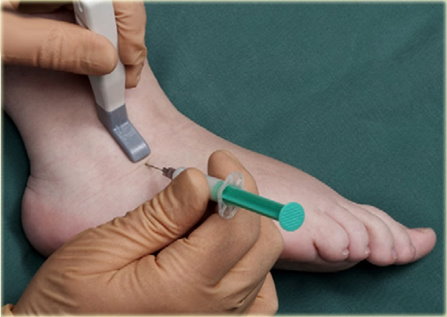 ultrasound guided joint injection