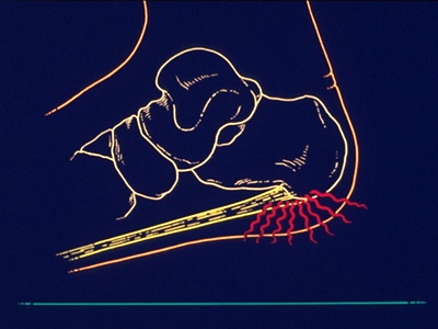 plantar fasciitis pain diagram