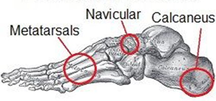 stress fracture diagram