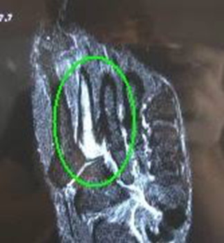 stress fracture MRI scan