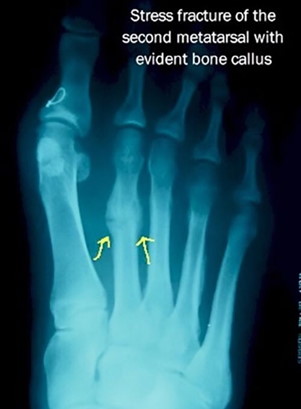 stress fracture xray
