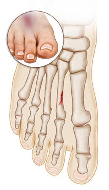 stress fracture 2nd metatarsal