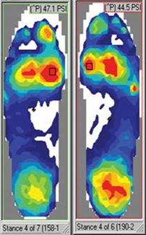 foot pressure mapping