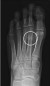 stress fractures thumbnail